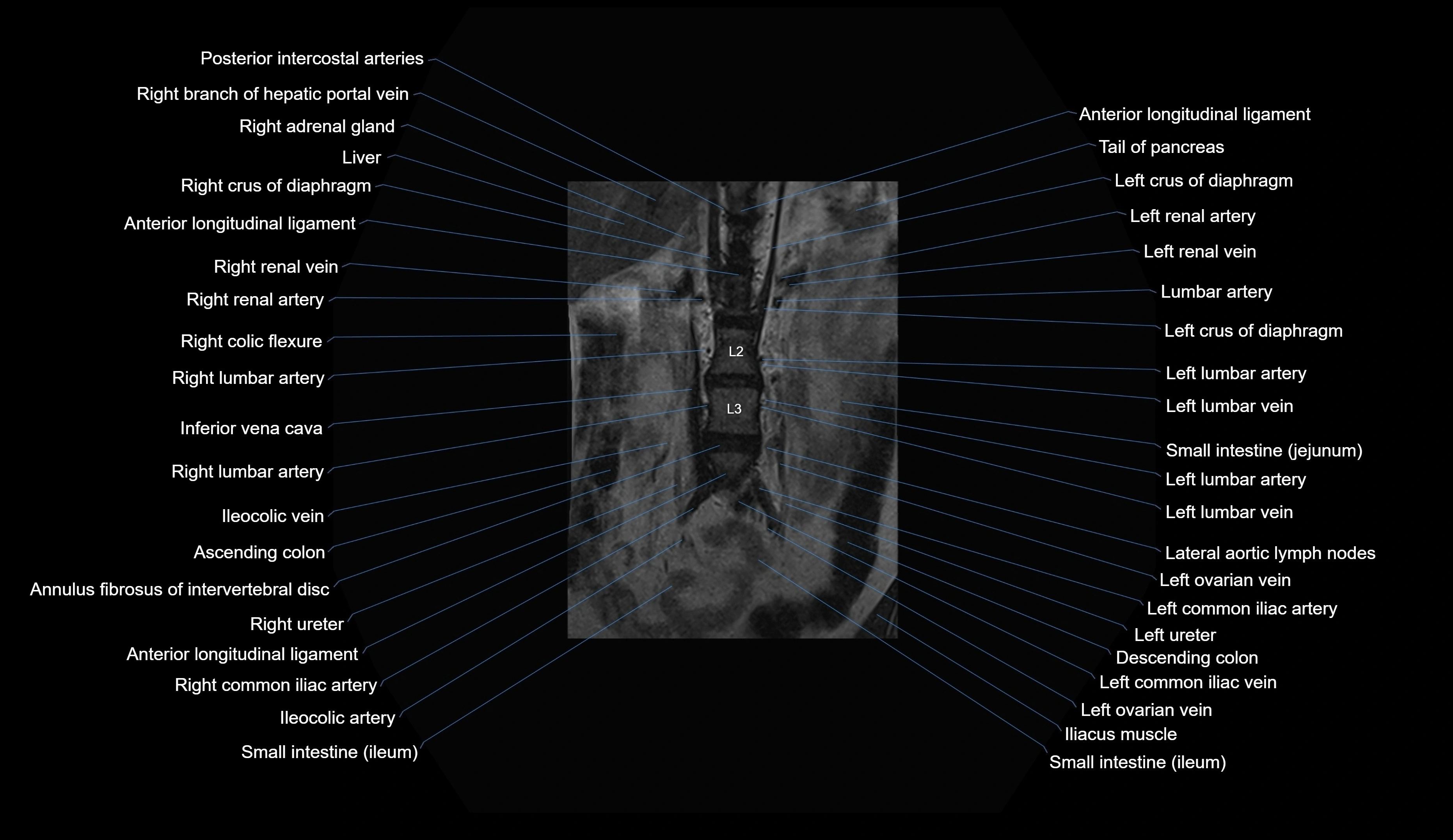 MRI lumbar spine coronal cross sectional anatomy 3T radiology  image-img-00001-00005.webp